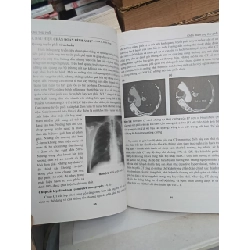 Ung thư phổi (sách chuyên khảo) - PGS.TS. Huỳnh Quyết Thắng