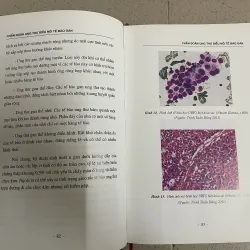 Ung thư biểu mô tế bào gan – Các phương pháp điều trị can thiệp nội mạch  763552