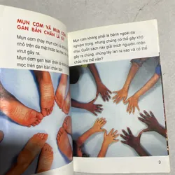 Mụn cơm - bệnh lây 589695
