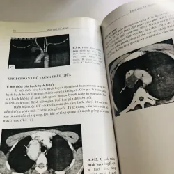 HÌNH ẢNH CT NGỰC 756244