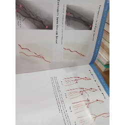 Patel's Atlas of Transradial Intervention: The Basics - Tejas Patel, Sanjay Shah, Alok Ranjan 1060253