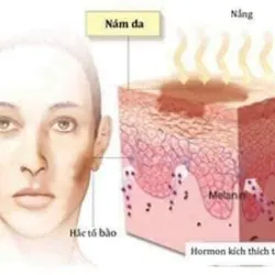 Kem trị nám, thâm xách tay Hàn Quốc 971583