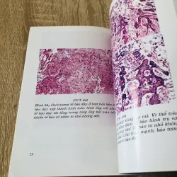 U ÁC TÍNH VÙNG MIỆNG - HÀM MẶT  933205