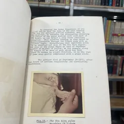 HOU KEOU, A PROGNOSTIC SIGN IN CHILDREN - PHAN TIÊN THÁI 590862