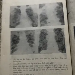 Những sai lâm chẩn đoán bệnh lao phổi - B.s. GHEORGHE BUNGETIANU - B.s. MIHAIL BUZESCU 1022807