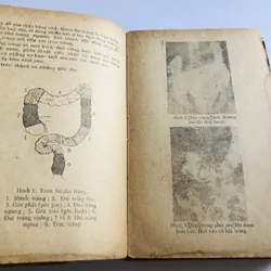 UNG THƯ ĐẠI TRÀNG 707184