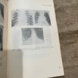 NHỮNG SAI LẦM TRONG CHẨN ĐOÁN BỆNH LAO PHỔI 573053