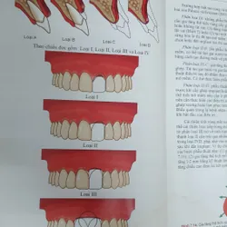 CẤY GHÉP NHA KHOA 740877
