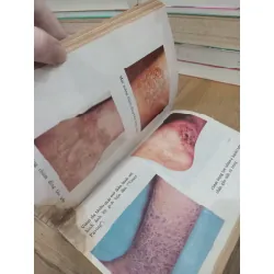 Bệnh chàm - S.J.Kawalkar, M.D, D.V.D, G.Blum, M.D 721100