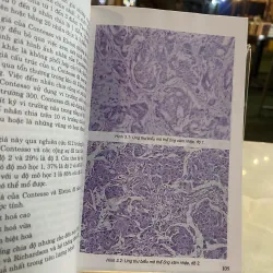 BỆNH UNG THƯ VÚ - NGUYỄN BÁ ĐỨC 757170