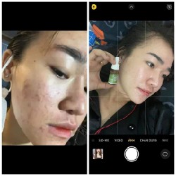 Serum diếp cá IGREEN dành cho da mụn 99491