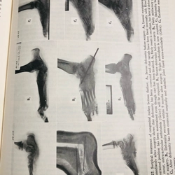 CAMPBELL’S OPERATIVE ORTHOPAEDICS (phẫu thuật chỉnh hình) 470882