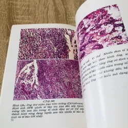 U ÁC TÍNH VÙNG MIỆNG - HÀM MẶT  933205