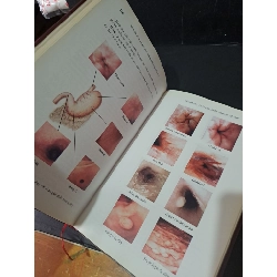 Bệnh dạ dày - tá tràng và nhiễm Helicobacter Pylori (bìa cứng) mới 80% bẩn nhẹ 2008 Trần Thiện Trung HCM1604 SỨC KHỎE - THỂ THAO 918794