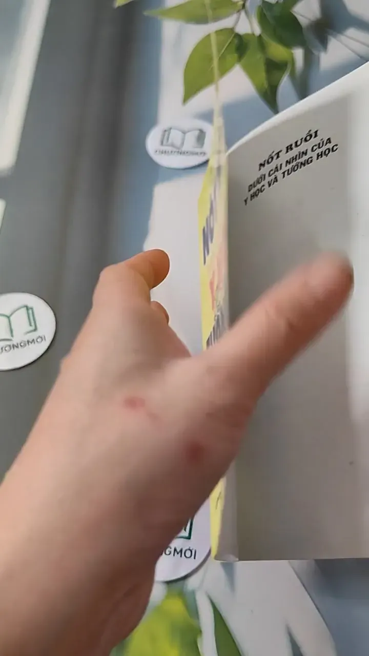 Nốt Ruồi Dưới Cái Nhìn Y Học & Tướng Học - Như Hùng 727280