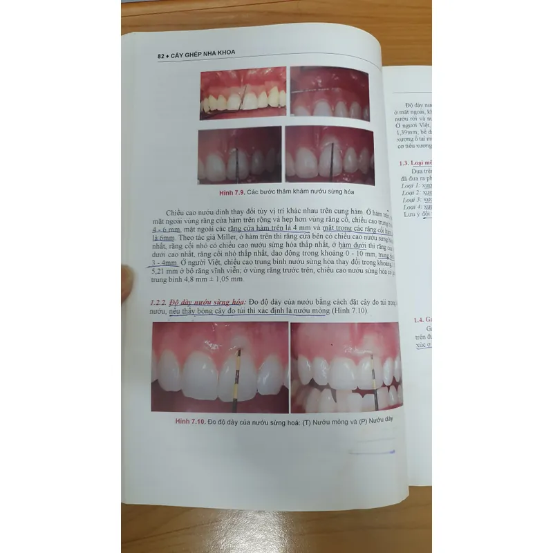 CẤY GHÉP NHA KHOA 740877