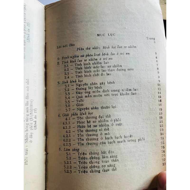 LAO SƠ NHIỄM Ở TRẺ EM 529550
