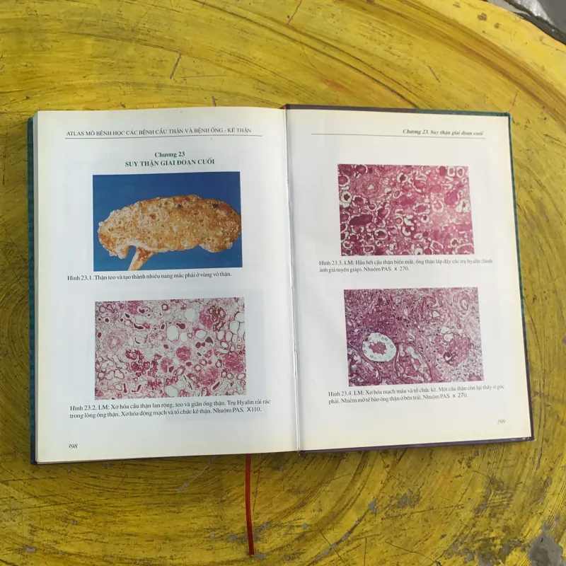 ATLAS MÔ BỆNH HỌC CÁC BỆNH CẦU THẬN & BỆNH ỐNG - KẼ THẬN 1009009