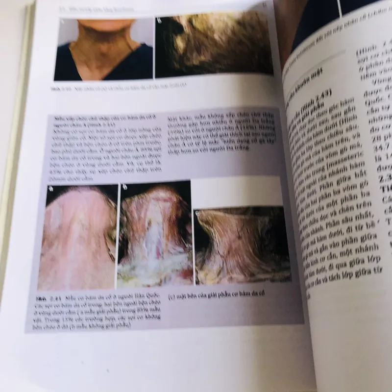 TIÊM BOTULINUM TOXIN VÀ CHẤT LÀM ĐẦY 568271