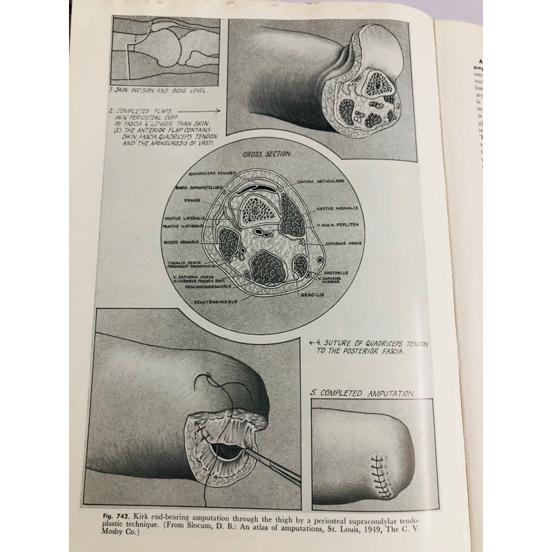 CAMPBELL’S OPERATIVE ORTHOPAEDICS ( chỉnh hình phẫu thuật) 470880