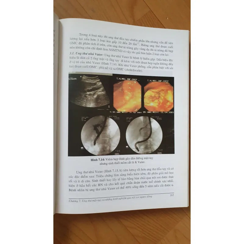 NỘI SOI MẶT TUY  754032