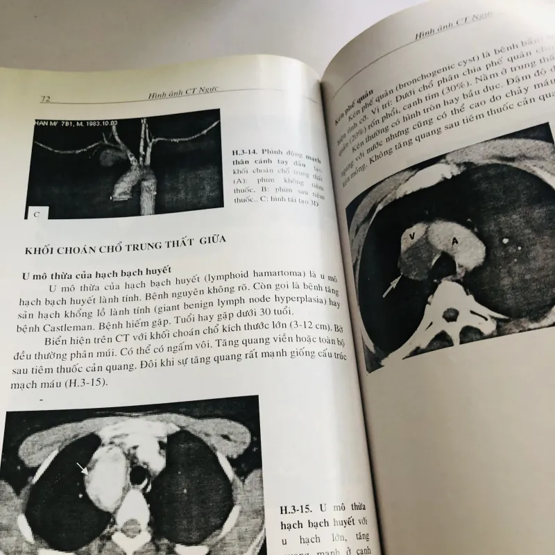 HÌNH ẢNH CT NGỰC 756244