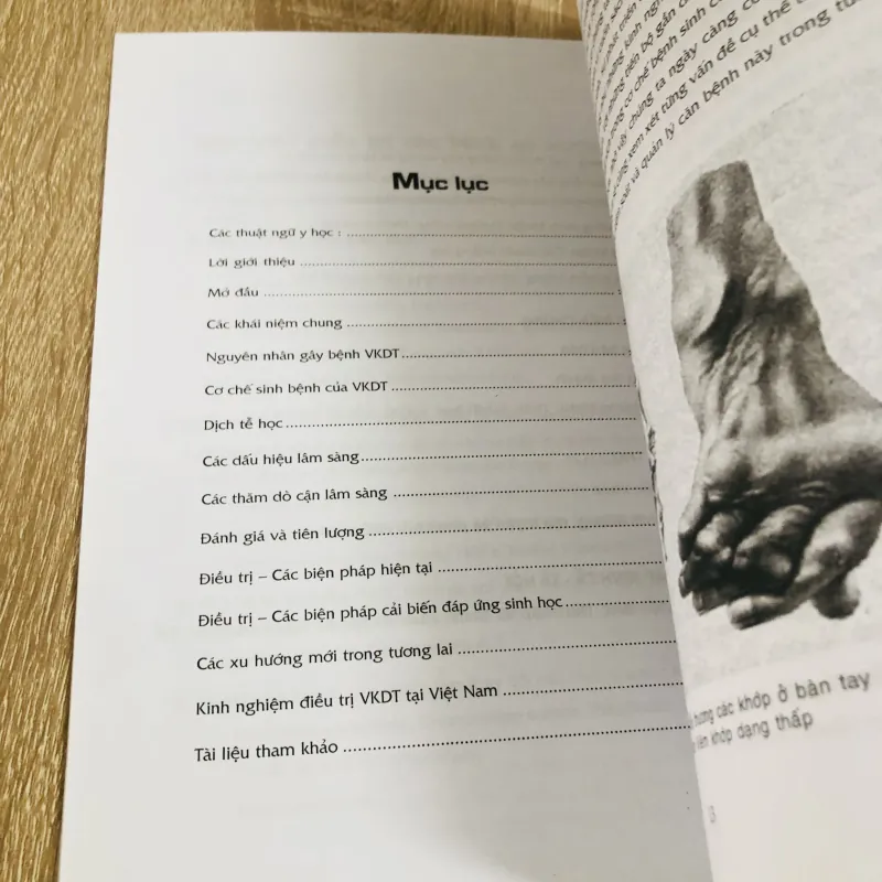 BỆNH VIÊM KHỚP DẠNG THẤP  1017620