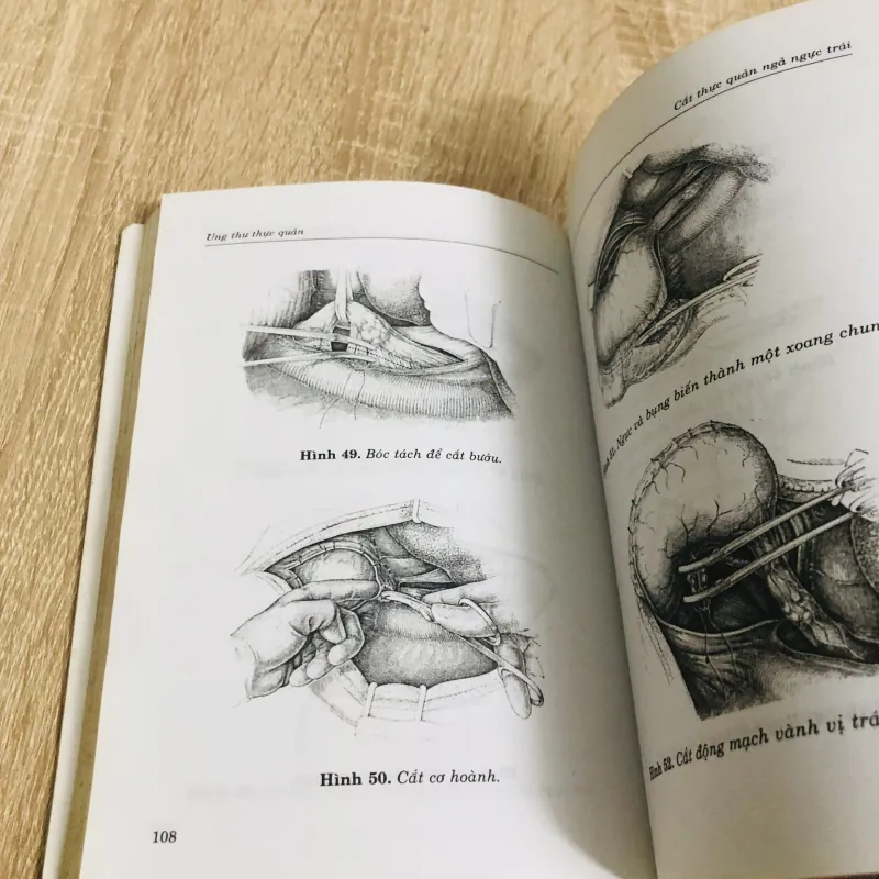 UNG THƯ THỰC QUẢN  934002