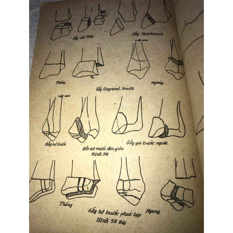 Gẫy Xương Chi Trên-Nhiều Tác Giả 971692