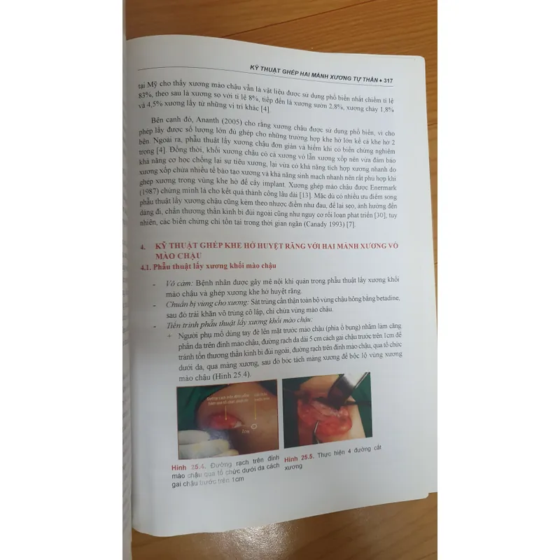 CẤY GHÉP NHA KHOA 740877