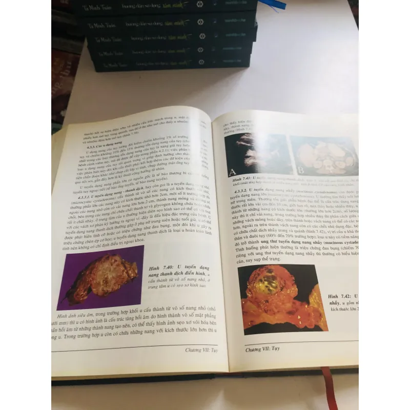 SIÊU ÂM BỤNG TỔNG QUÁT 2006 756264