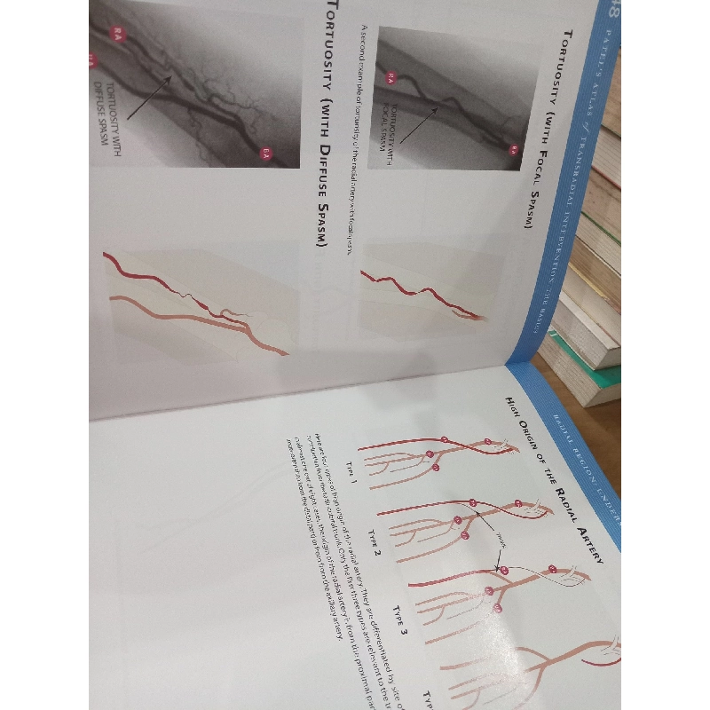 Patel's Atlas of Transradial Intervention: The Basics - Tejas Patel, Sanjay Shah, Alok Ranjan 1060253
