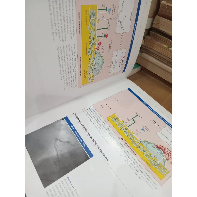 Atlas of Atherothrombosis - Editor-in-Chief: Eric J Topol 1024410