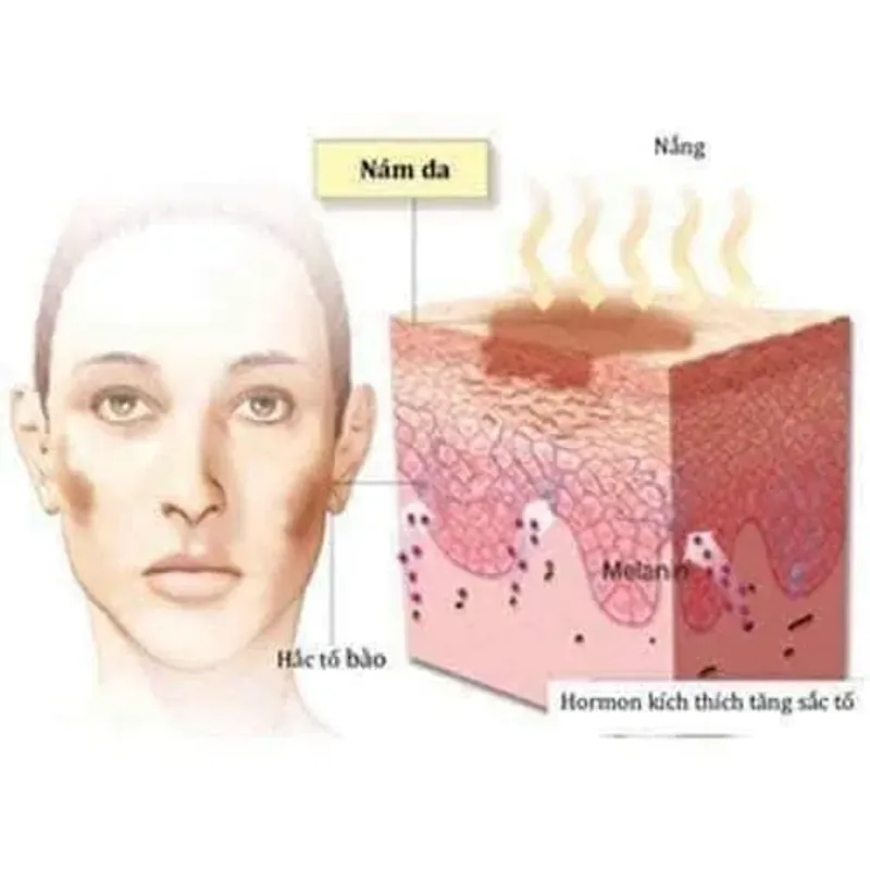 Kem trị nám, thâm xách tay Hàn Quốc 971583