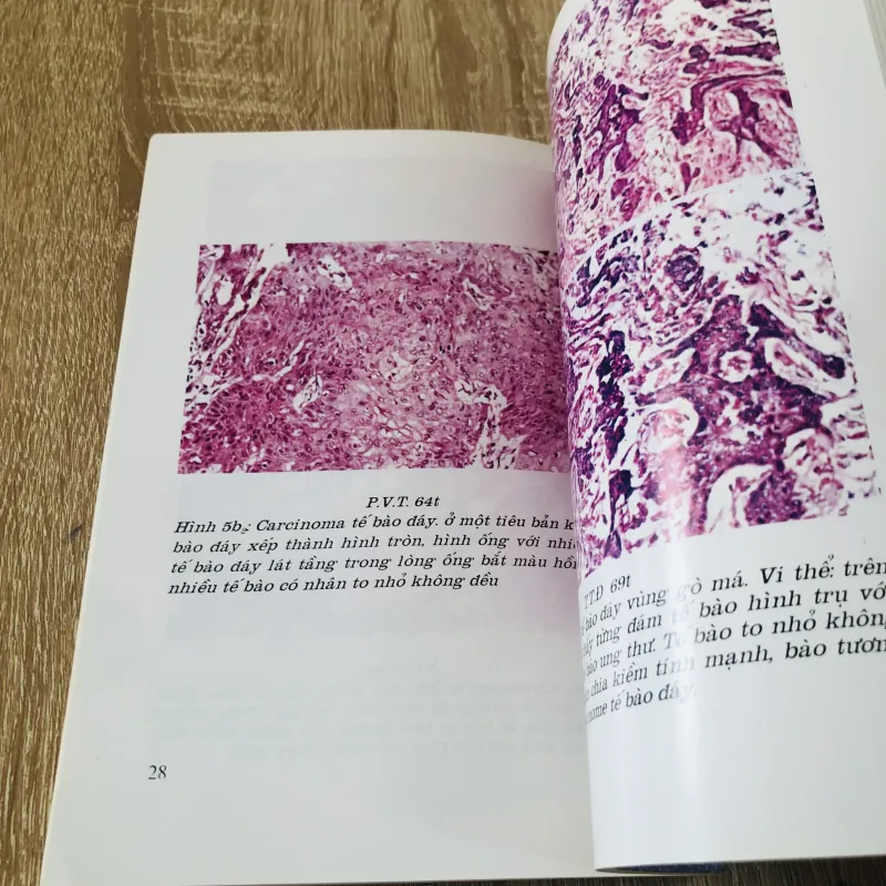 U ÁC TÍNH VÙNG MIỆNG - HÀM MẶT  933205