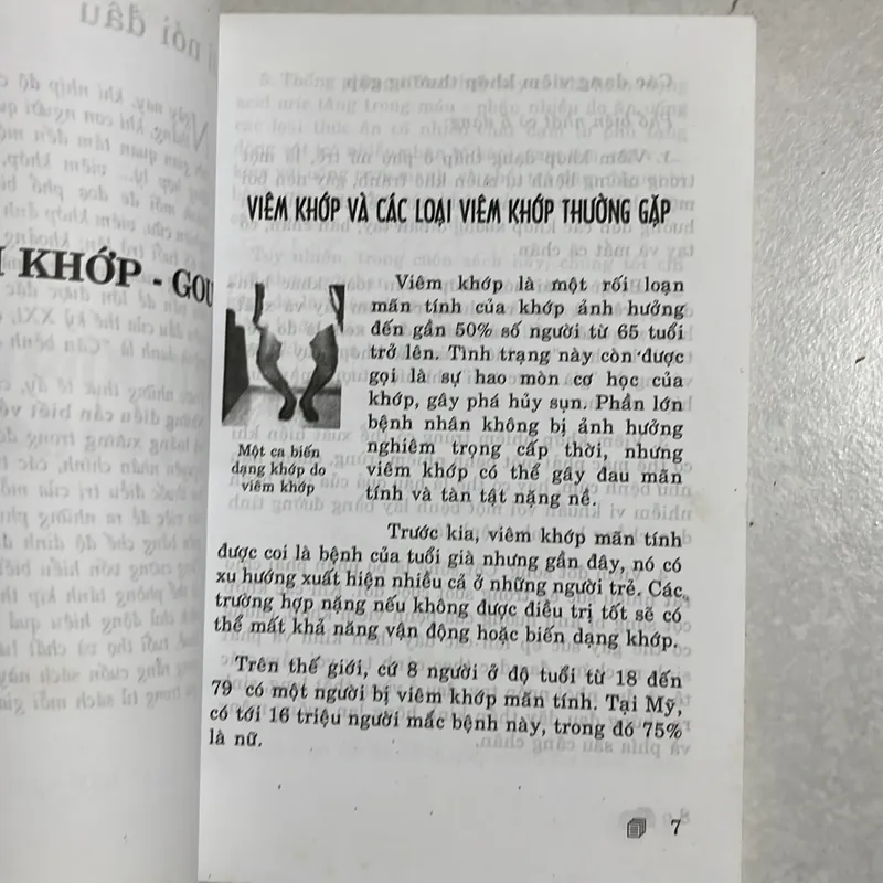 Viêm khớp - Gout và loãng sương 589716