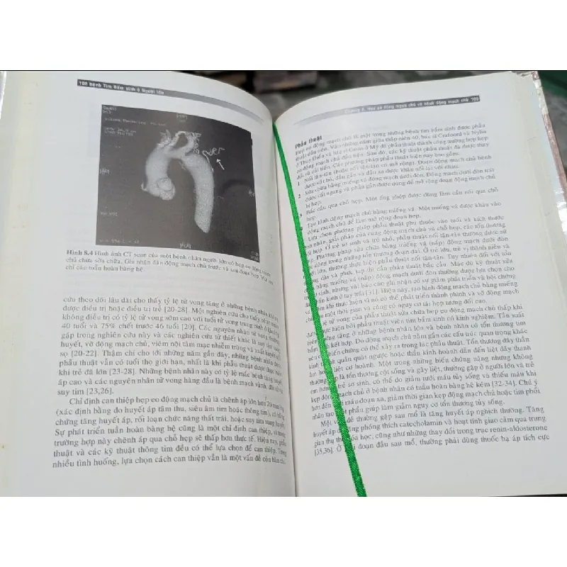 Bệnh tim bẩm sinh ở người lớn - Carole A.Warnes - Hiệu đính dịch thuật: PGS.TS.Phạm Nguyễn Vinh 271525