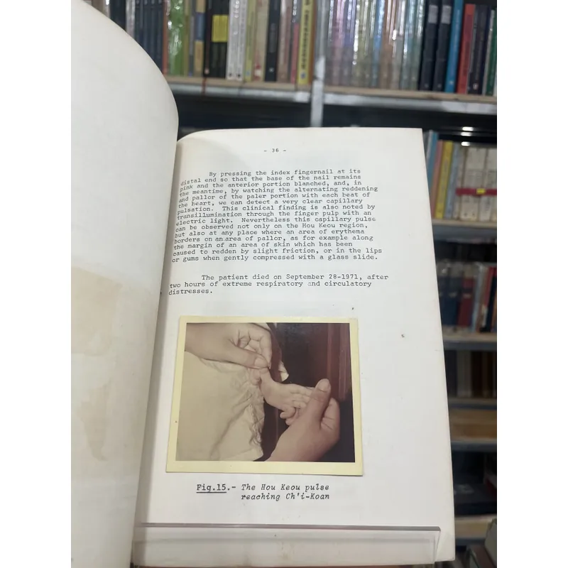HOU KEOU, A PROGNOSTIC SIGN IN CHILDREN - PHAN TIÊN THÁI 590862