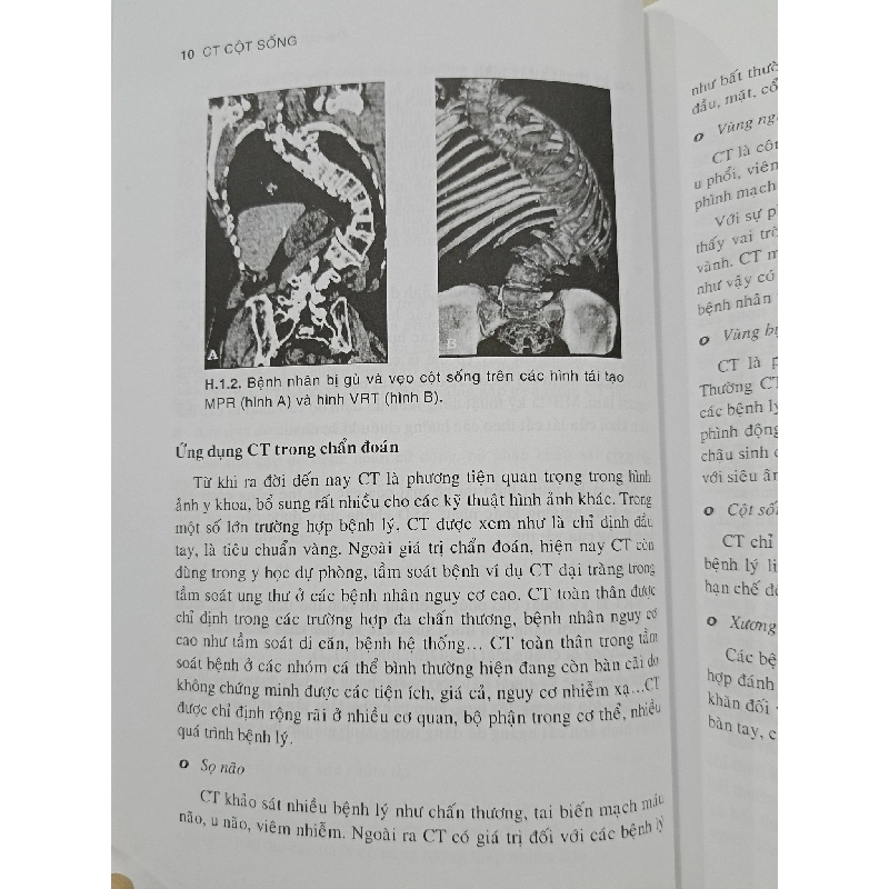 CT cột sống - TS. Phạm Ngọc Hoa, ThS. Lê Văn Phước 934485