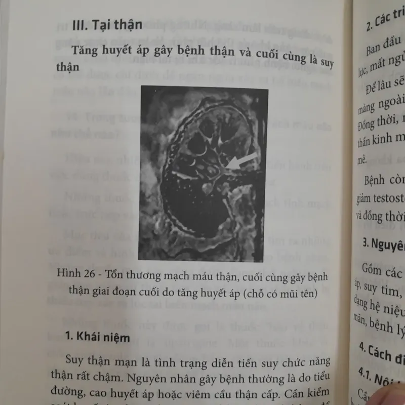 Bệnh tăng huyết áp Cách phòng và điều trị. Bác sỹ Bạch Minh 589221