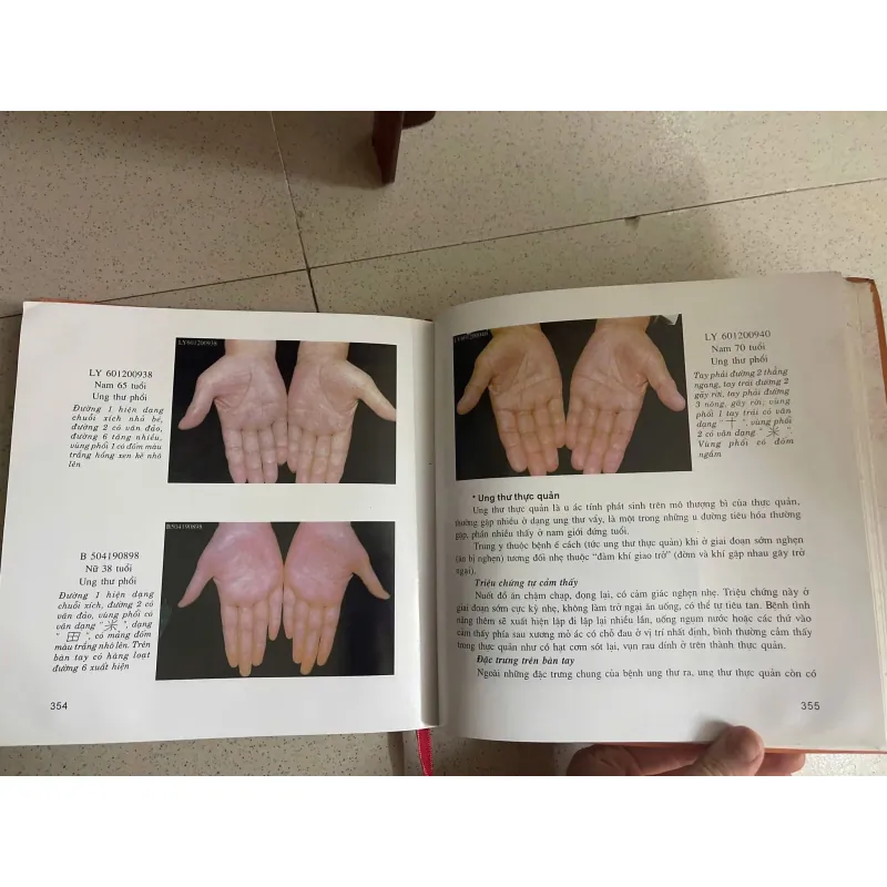 Chuẩn đoán bệnh qua vân tay 585366