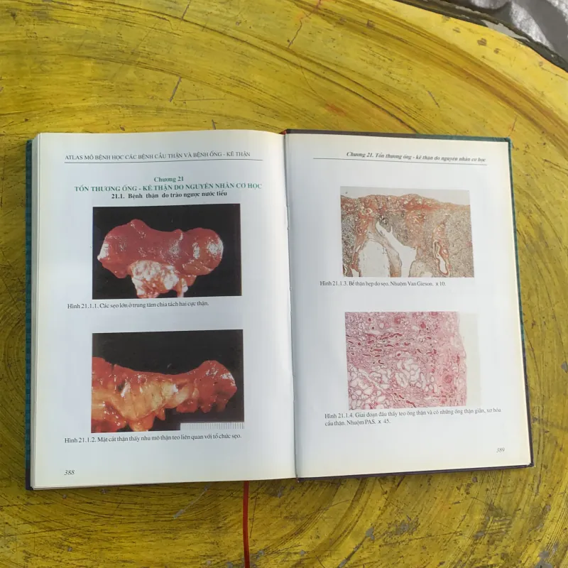 ATLAS MÔ BỆNH HỌC CÁC BỆNH CẦU THẬN & BỆNH ỐNG - KẼ THẬN 1009009