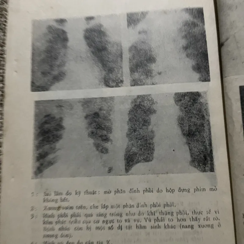Những sai lâm chẩn đoán bệnh lao phổi - B.s. GHEORGHE BUNGETIANU - B.s. MIHAIL BUZESCU 1022807