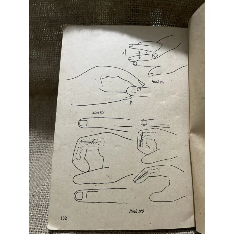 Gãy xương chị trên -1983 800113