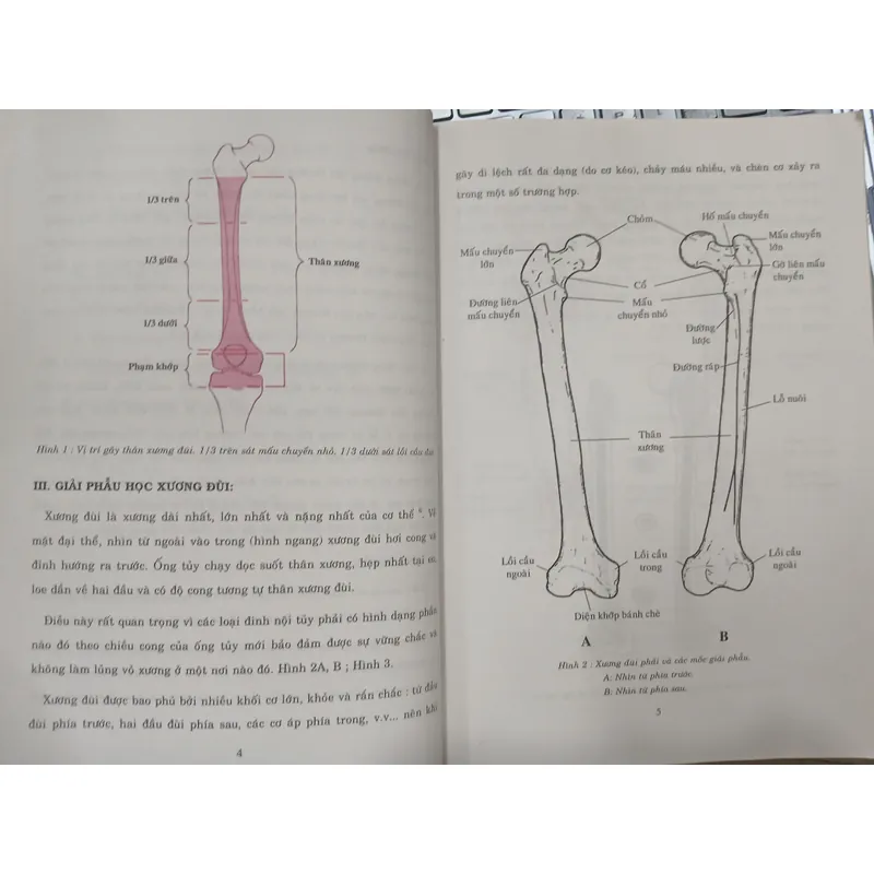 GÃY THÂN XƯƠNG ĐÙI - TỔN THƯƠNG, CHẨN ĐOÁN, ĐIỀU TRỊ 595415