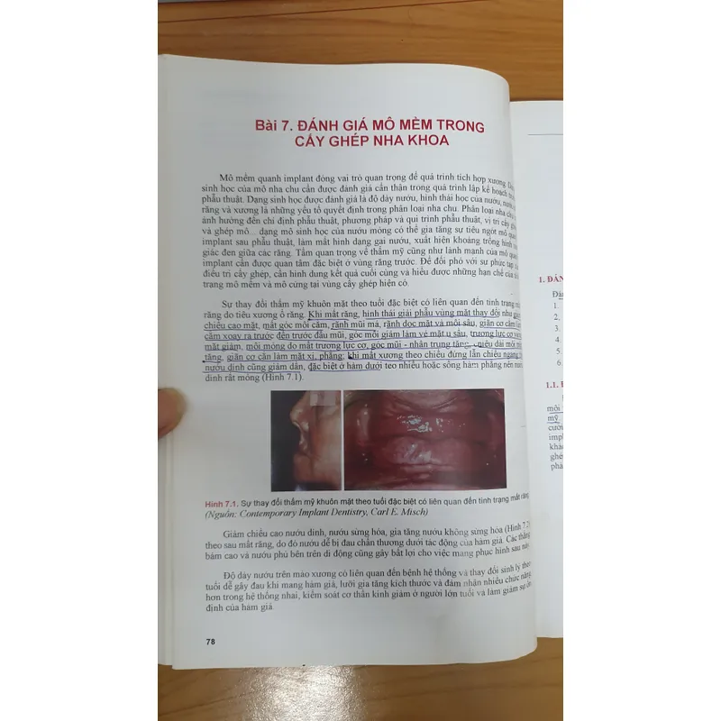 CẤY GHÉP NHA KHOA 740877