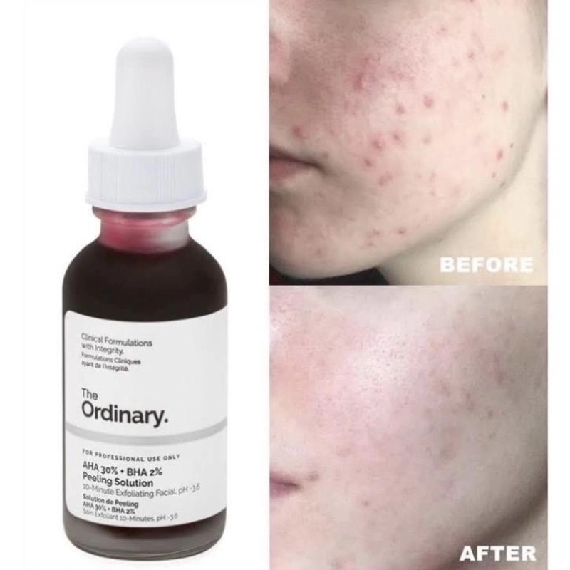 Tinh Chất Peel da The Ordinary AHA 30%+BHA 2% Peeling Solution 30ml (cosme) 445766