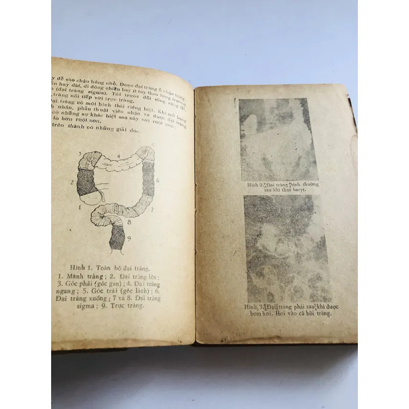 UNG THƯ ĐẠI TRÀNG 707184