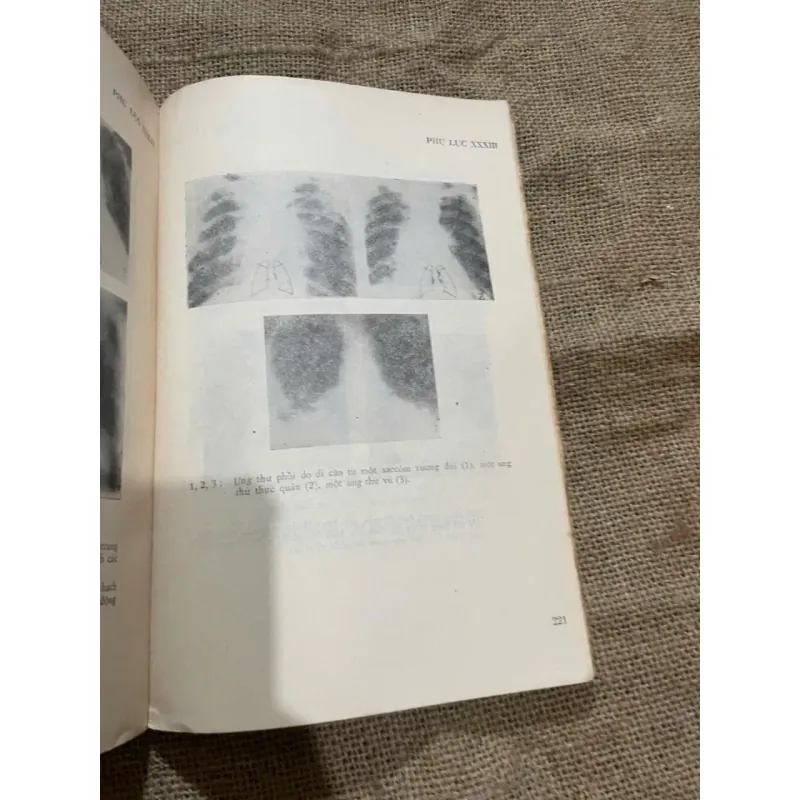 NHỮNG SAI LẦM TRONG CHẨN ĐOÁN BỆNH LAO PHỔI 573053