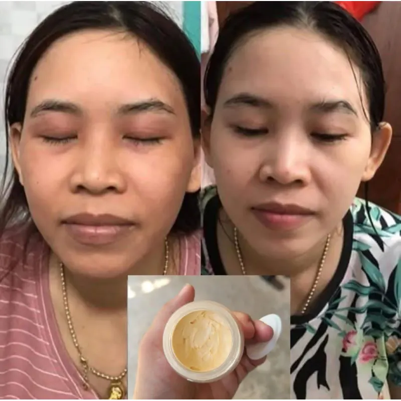 Kem trị nám, thâm xách tay Hàn Quốc 971583